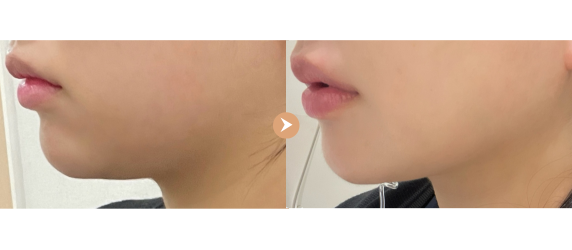  전후사진