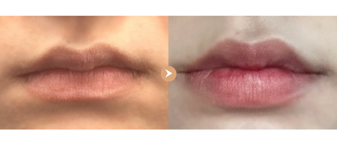  전후사진