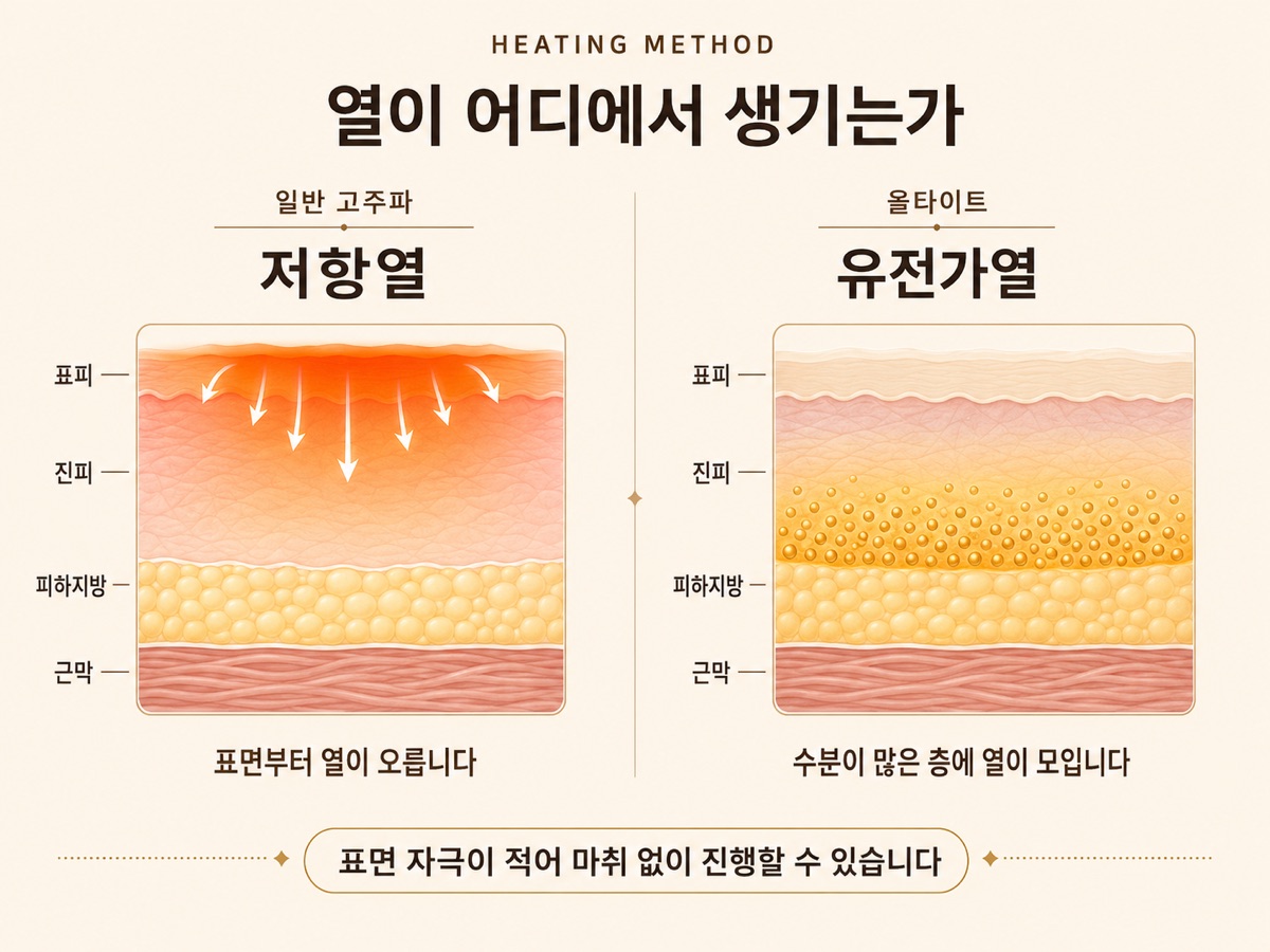 열이 어디에서 생기는가 — 일반 고주파는 저항열로 표피 쪽부터 열이 오르고, 올타이트의 유전가열은 수분이 많은 진피층에 열이 모입니다. 표면 자극이 적어 마취 없이 진행할 수 있습니다