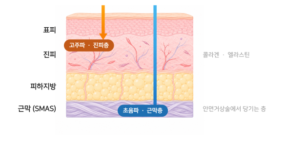 초음파는 근막(SMAS)층, 고주파는 진피층에 작용합니다